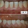 歯周病の治療「歯周外科治療」｜歯茎の状態を劇的に改善