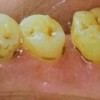 歯石とは ｜お口の中をのぞいて、白い塊があったら要注意！