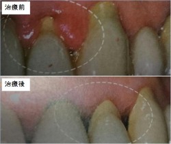 歯ぐきの腫れが改善した症例