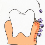 歯肉炎の主な症状としては、5つあります