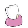 いつの間にか口の中にできる”白い塊”、それは歯石です